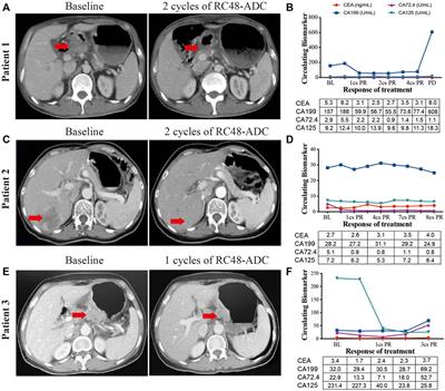 From AVATAR Mice to Patients: RC48-ADC Exerted Promising Efficacy in Advanced Gastric Cancer With HER2 Expression